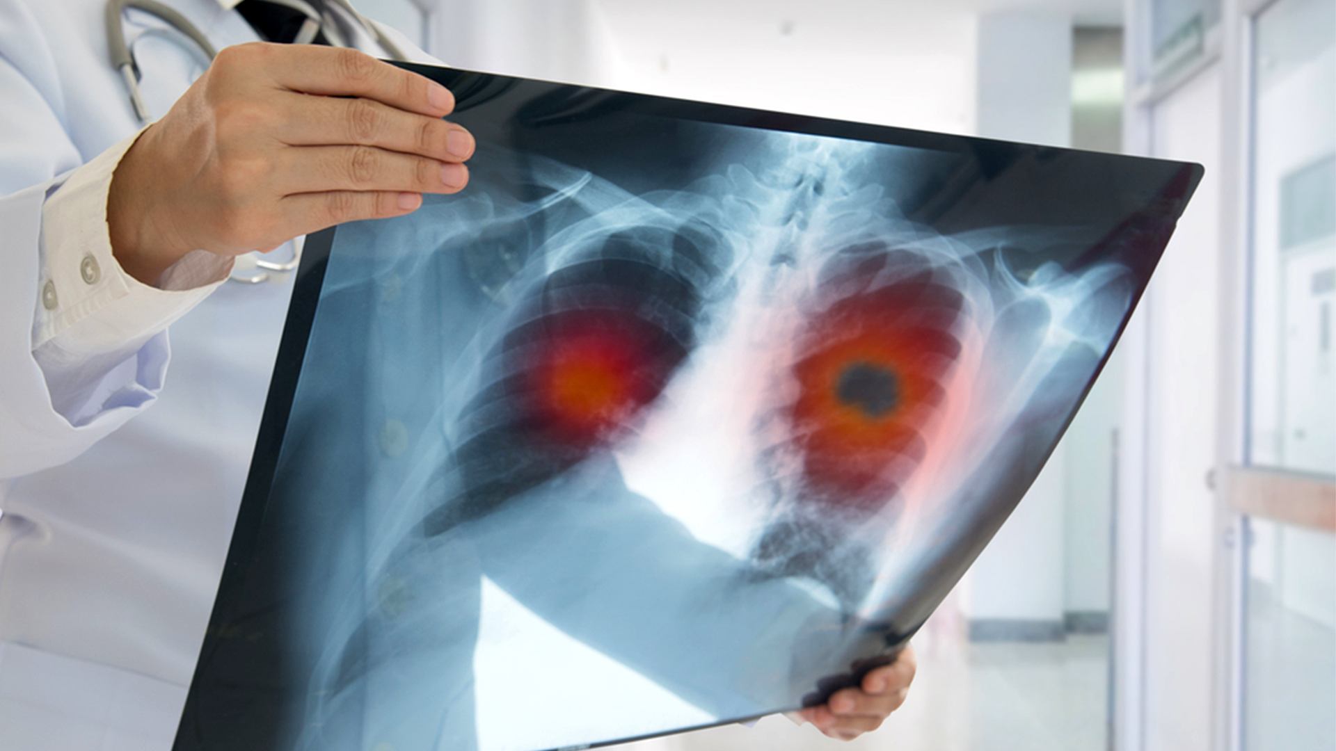What Are The Types & Precautions For Lung Cancer?