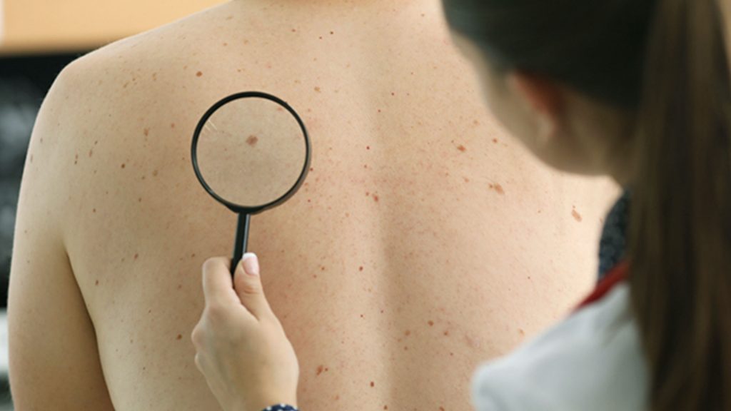 skin-cancer-some-question-that-need-answers