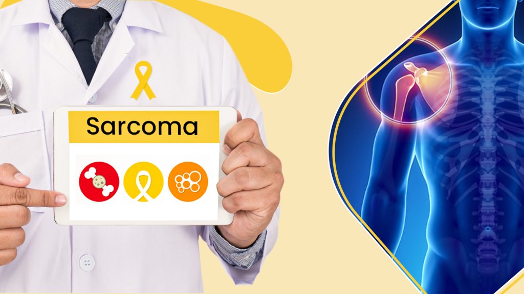 All you need to know about Sarcoma- the rare Cancer