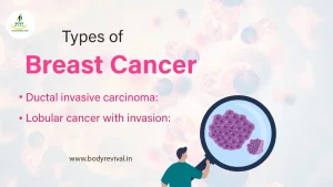 Types of breast cancer