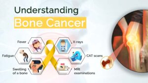 Understanding-Bone-Cancer-–-The-symptoms-causes-and-more