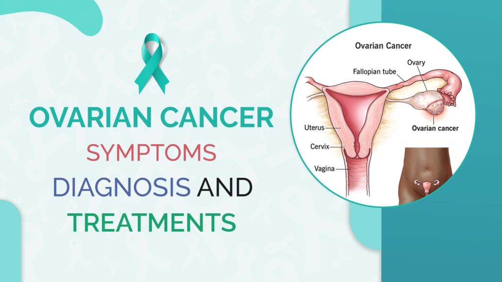 Ovarian-Cancer-Symptoms-diagnosis-and-treatments