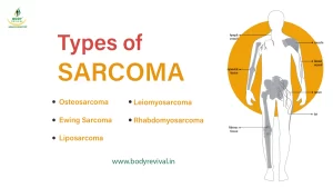 Types of sarcoma cancer