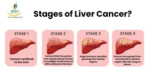 stages of Liver Cancer