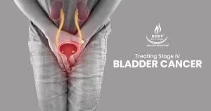Treating Stage IV Bladder Cancer