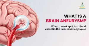 when a vein in the brain starts bulging out it leads to brain aneurysm