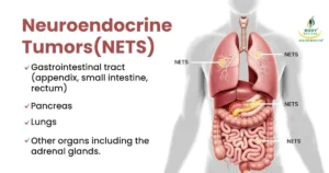 types of Neuroendocrine Tumors Bodyrevival cancer center