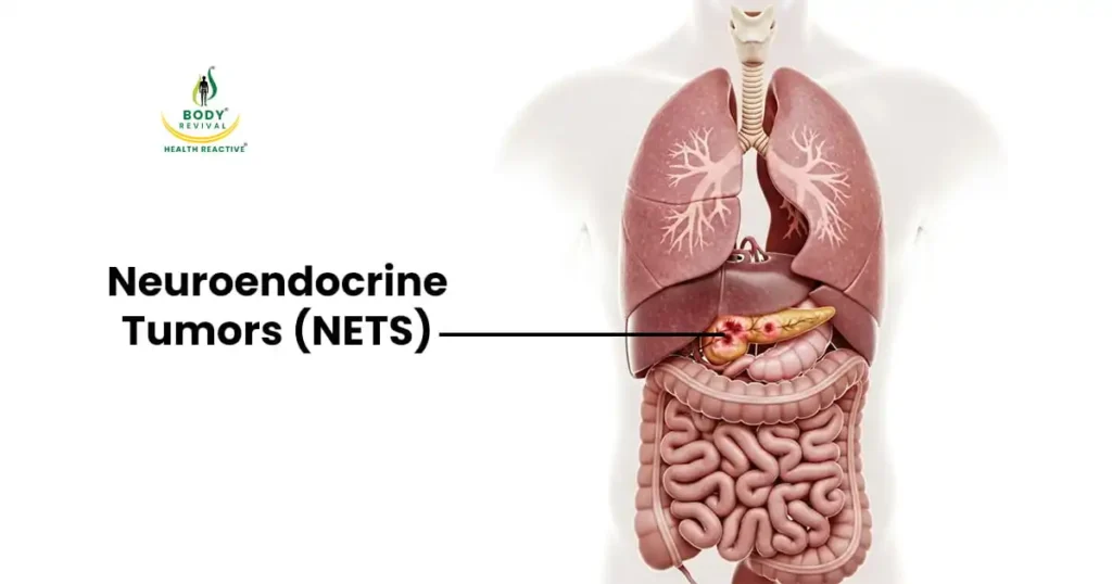 what is Neuroendocrine tumors