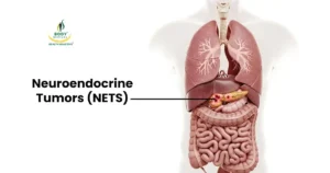 what is Neuroendocrine tumors